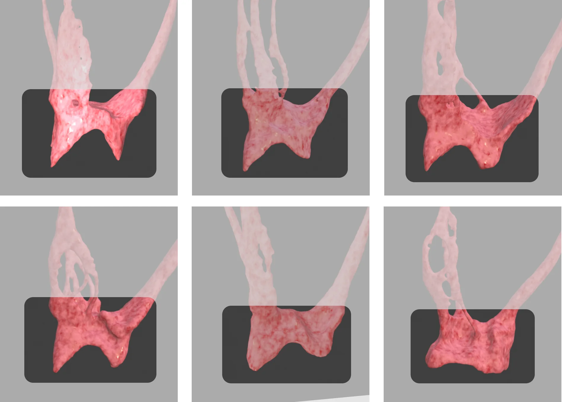 Maxillary first molar