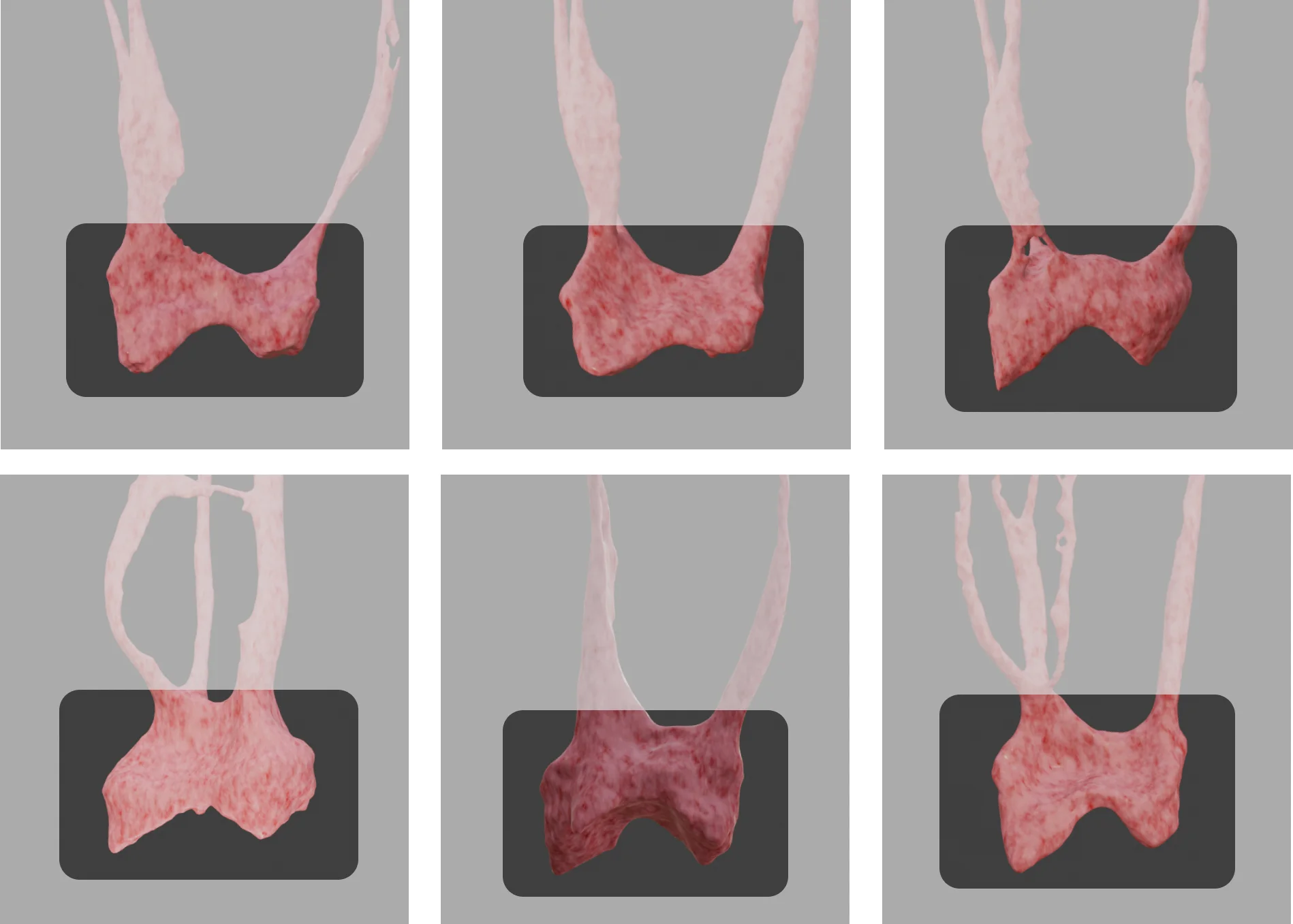 Maxillary Second Molar