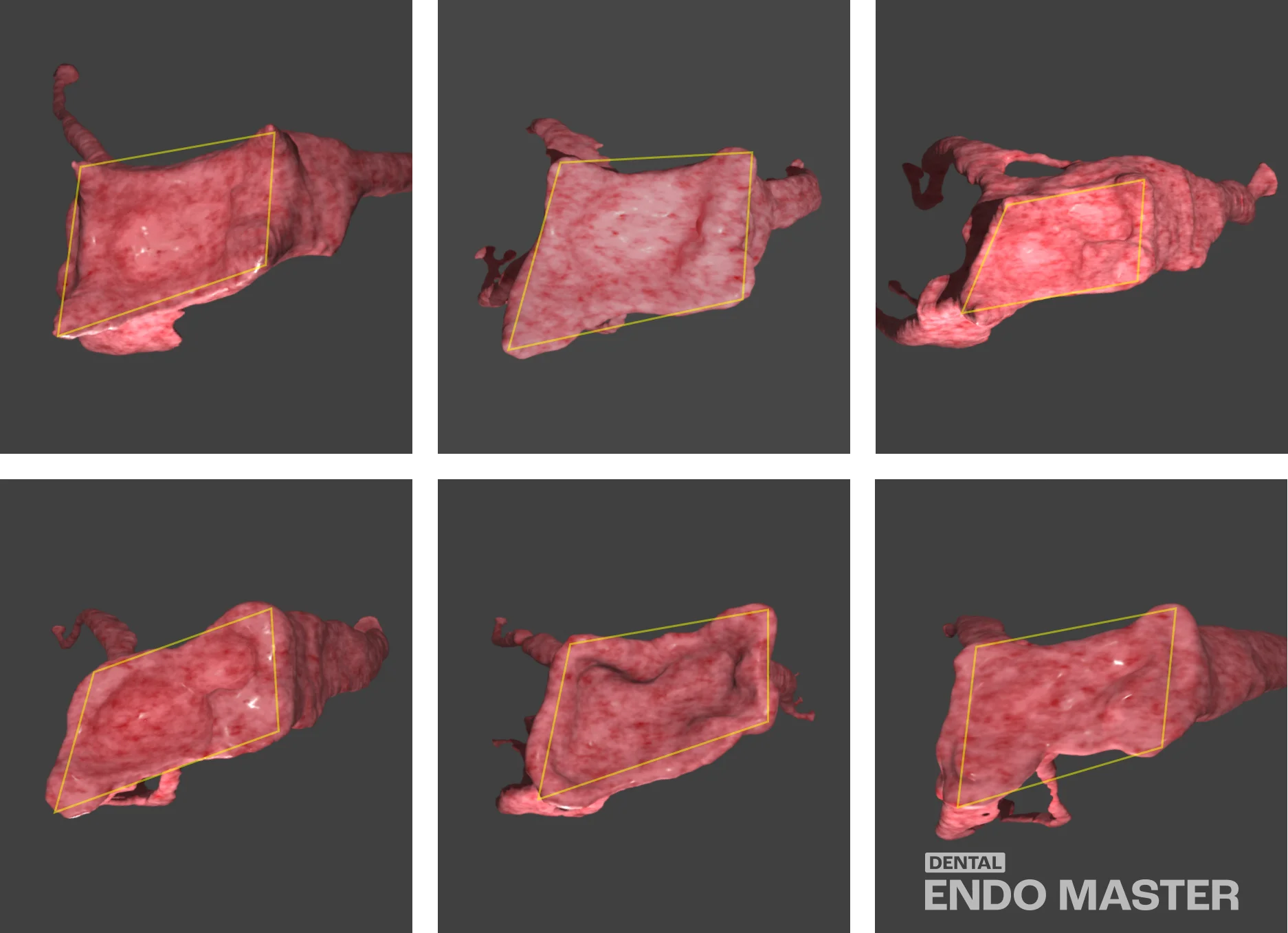  Pulp Horn Position and Shape of the Maxillary First Molar