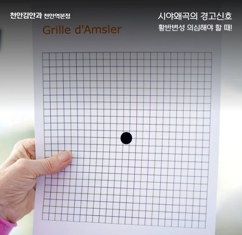 천안 황반변성