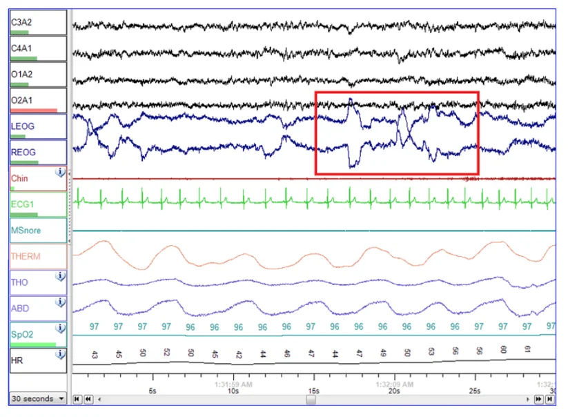 전문가의 판독이 없이는 해석이 거의 불가능한 PSG 검사지