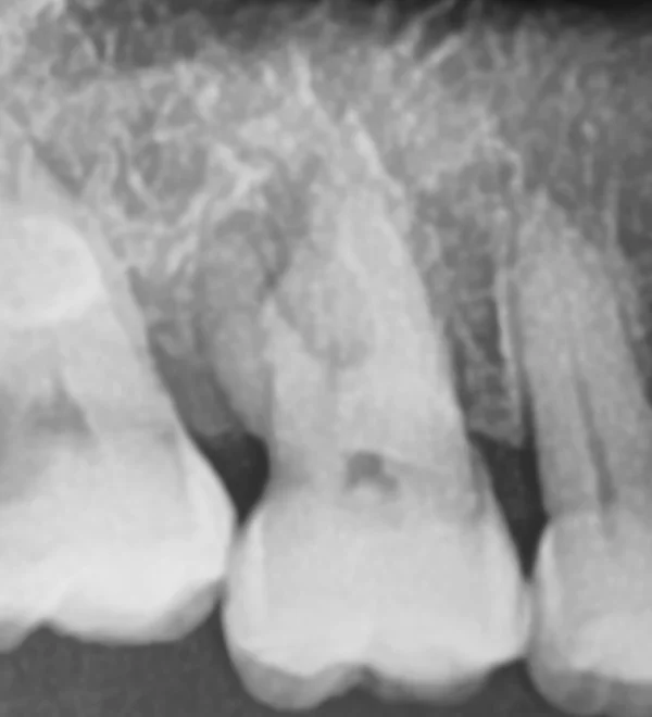 panoramic image of an upper molar