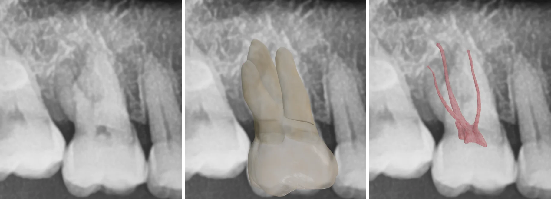 An image of a 3D model superimposed on a radiographic image.