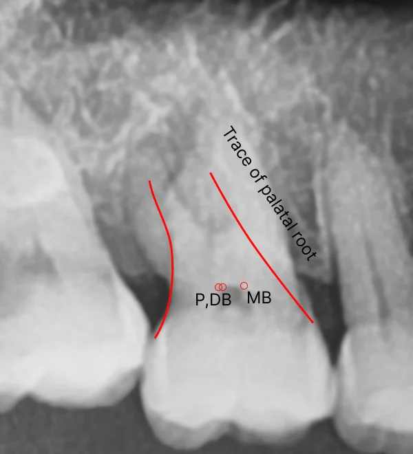 Tracing hidden palatal root 