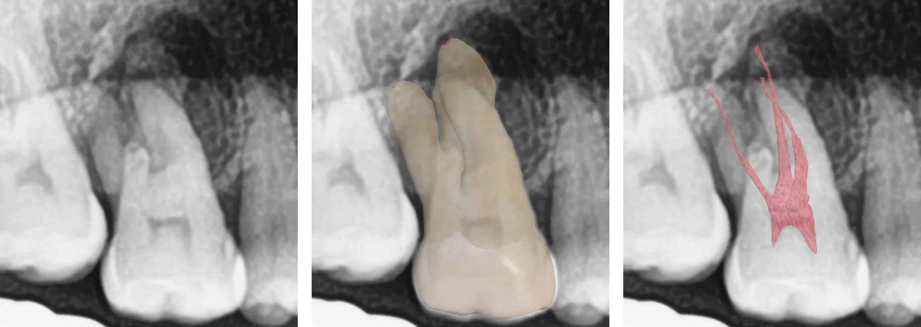 Dental x-ray, tooth and canal