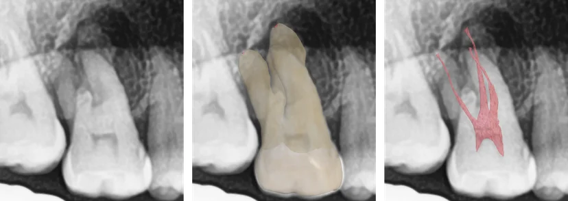 Dental x-ray, tooth and canal
