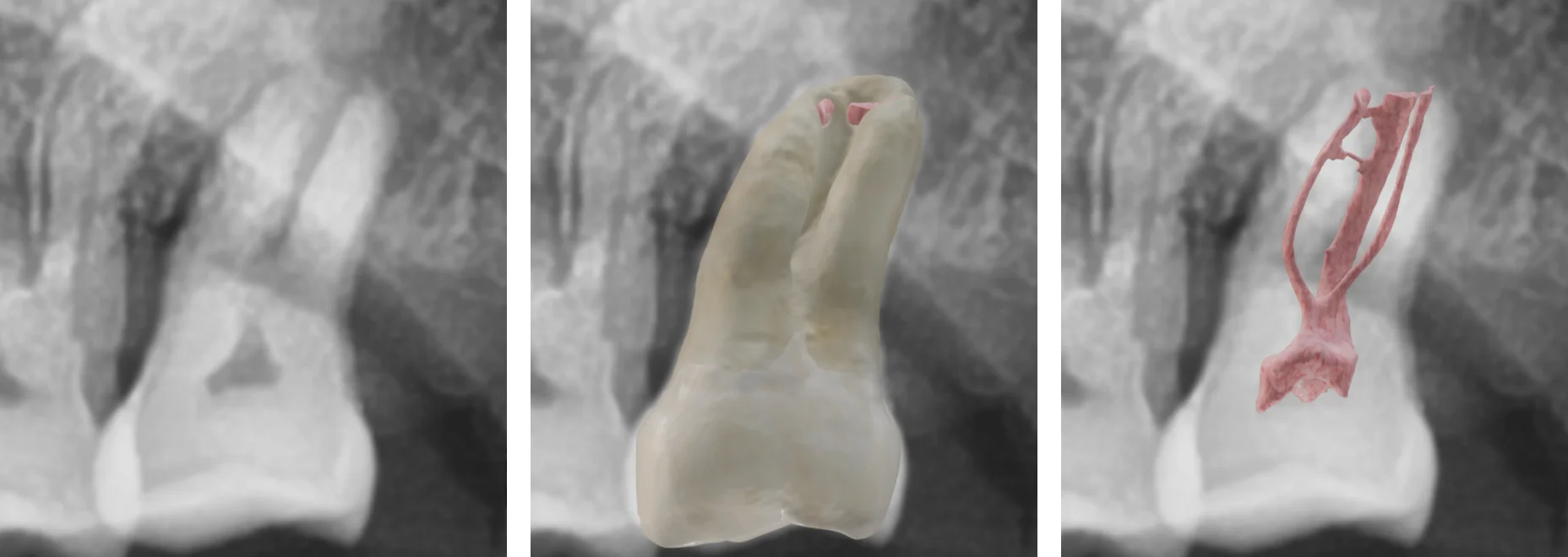 Dental x-ray, tooth and canal