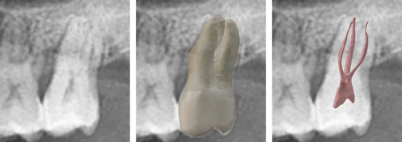 Dental x-ray, tooth and canal