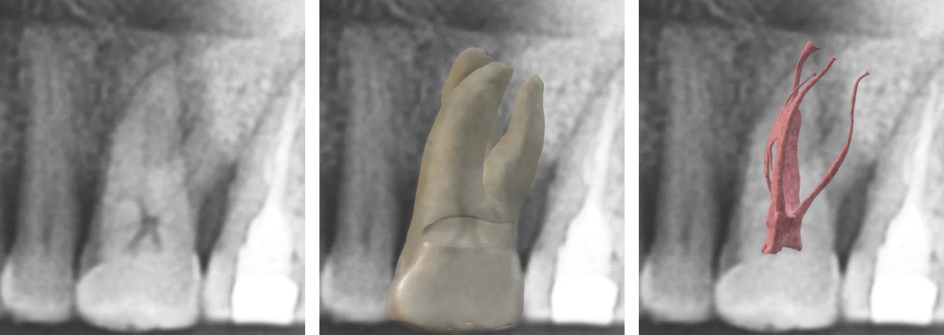 Dental x-ray, tooth and canal