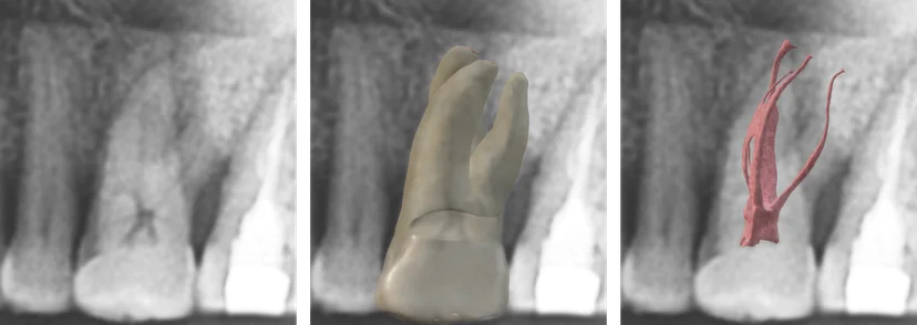 Dental x-ray, tooth and canal
