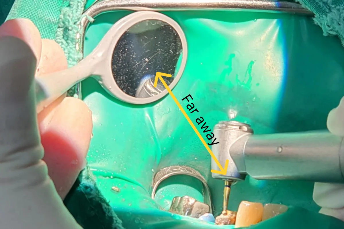 By keeping a sufficient distance between the dental mirror and the operating site, a clear field of view can be maintained.