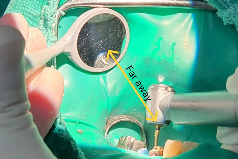 By keeping a sufficient distance between the dental mirror and the operating site, a clear field of view can be maintained.
