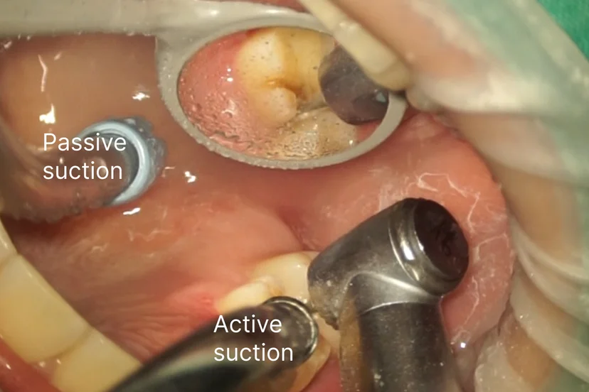 suction