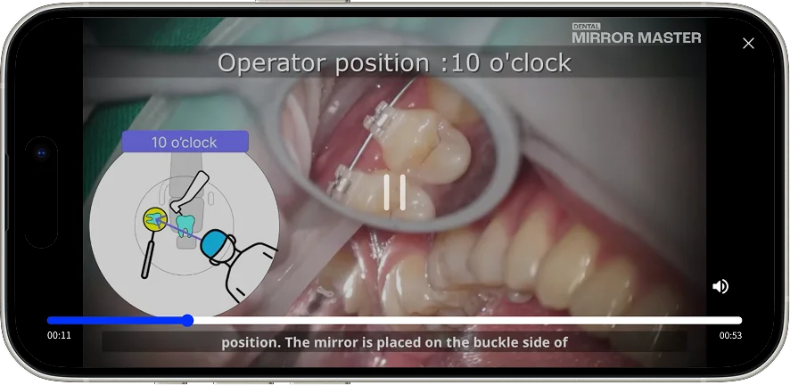 The video explains how to apply indirect vision techniques in clinical practice.