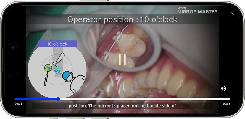 The video explains how to apply indirect vision techniques in clinical practice.