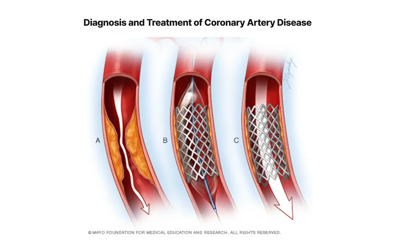 Medical illustration showing coronary artery disease progression and stent treatment: (A) narrowed artery with plaque buildup, (B) balloon angioplasty procedure, (C) deployed stent keeping artery open
