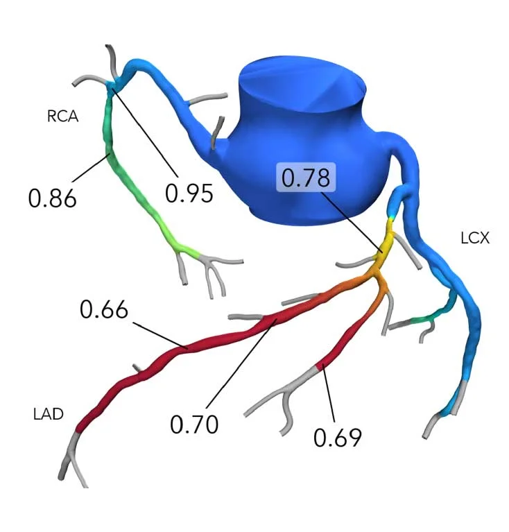 3D coronary artery model with FFR (Fractional Flow Reserve) values displayed showing RCA, LAD, and LCX vessels with numerical measurements ranging from 0.66 to 0.95 indicating blood flow reserve