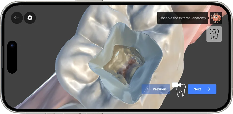 Using MCT-based models to clearly visualize the pulp chamber and canal orifices inside prepared teeth.