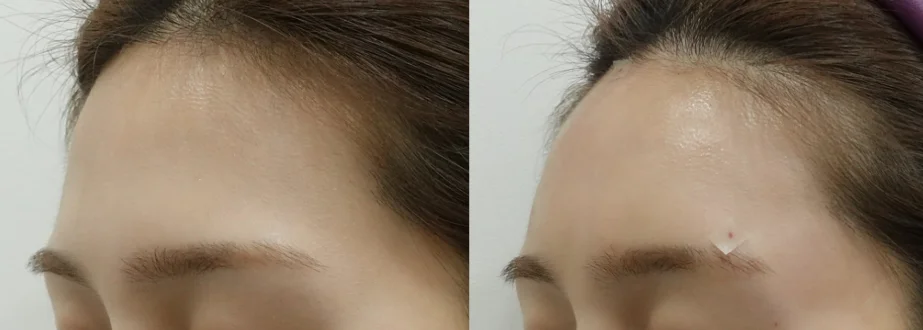 이마필러 시술 전후 비교 사진