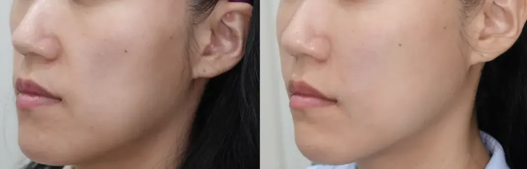 Juvelook Volume Before and After