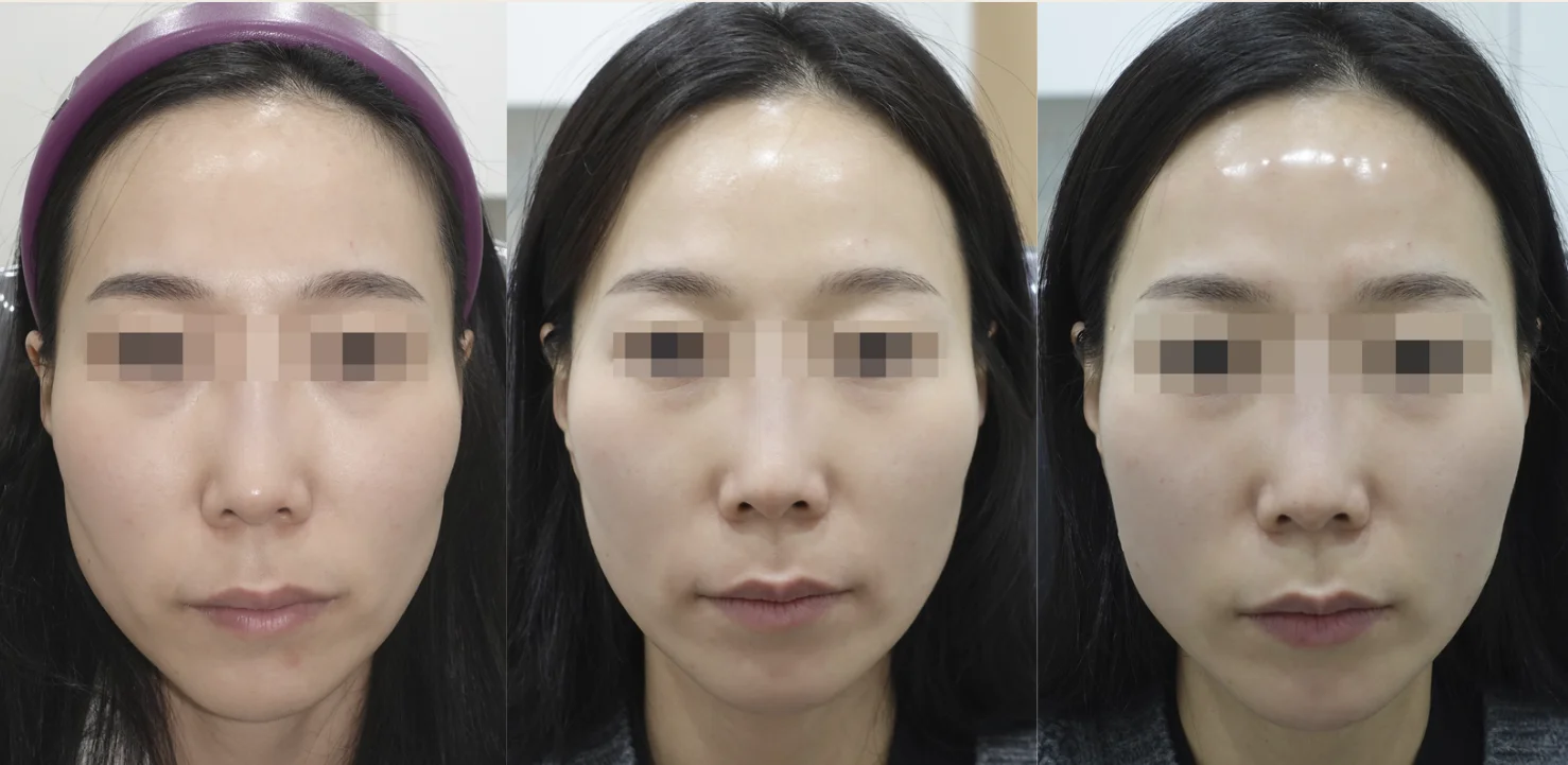 Combined 3 sessions of Juvelook Volume and Filler, Before and After
