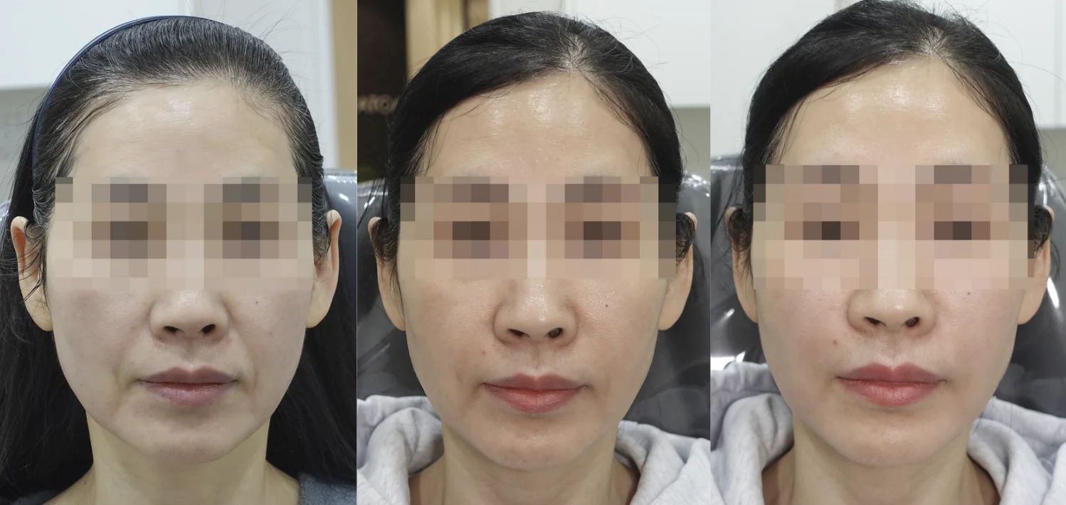 Before and After Radiesse Treatment