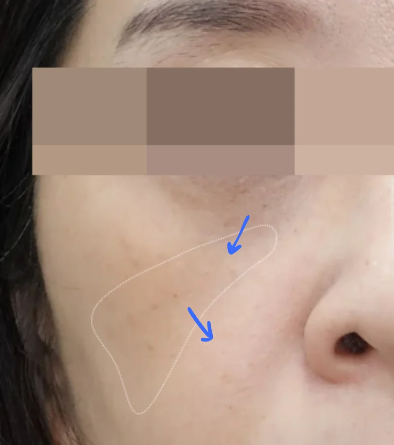 Recommended Volume Treatments for Tear Troughs and Anterior Cheeks