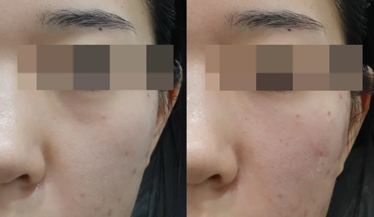 Before and After Volume Treatment for Tear Troughs and Anterior Cheeks