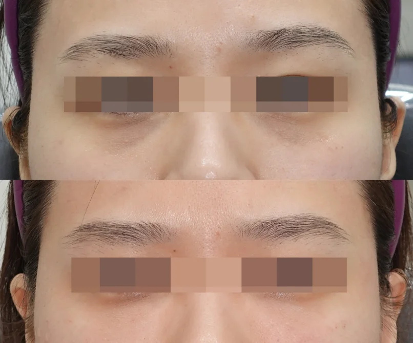 Before and After Restylane Eyelight Treatment