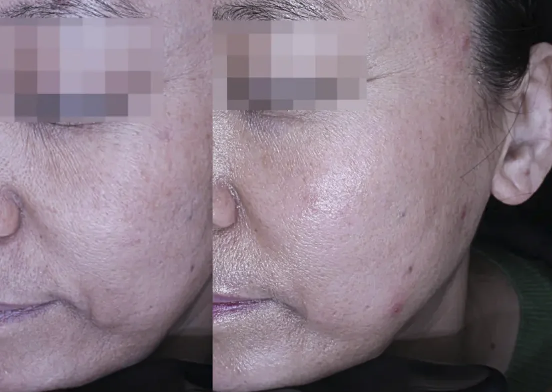 Tightening Treatments Enhance Skin Elasticity and Help Prevent Sagging