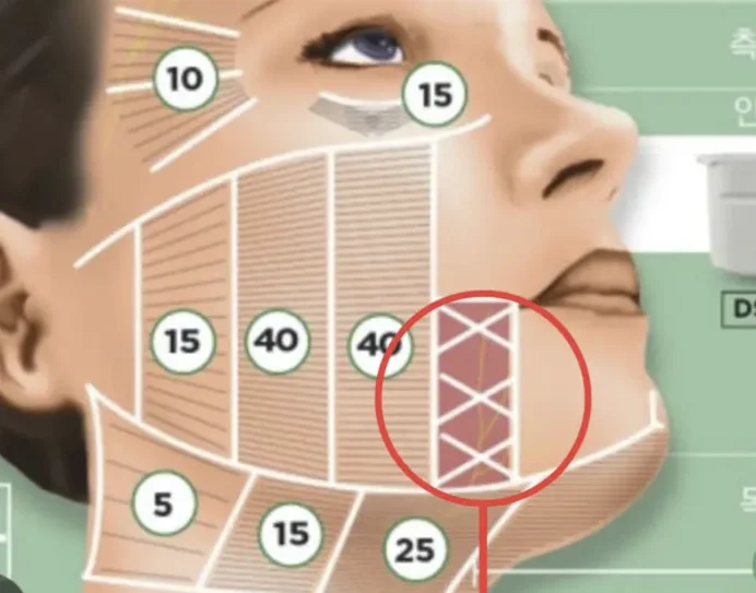 Perioral Areas Prone to Ultherapy Side Effects