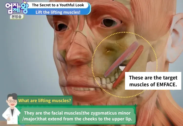 Primary Target Muscle of Emface