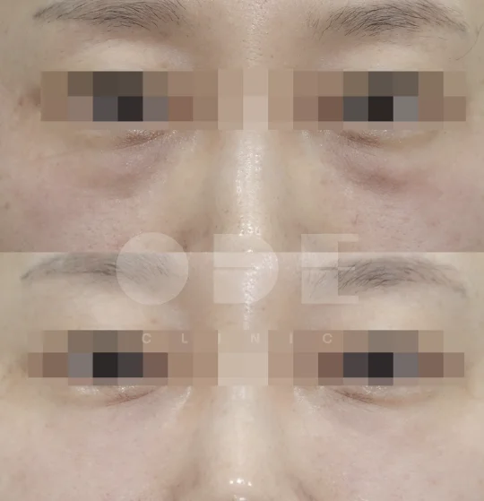 Actual UltraCol 200 under-eye results