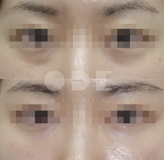 Actual UltraCol 200 under-eye results