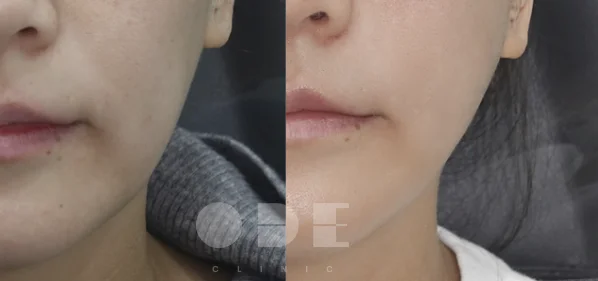 Actual UltraCol 200 nasolabial results