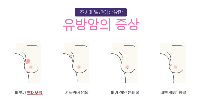 암요양병원찾기 | 유방암의 증상