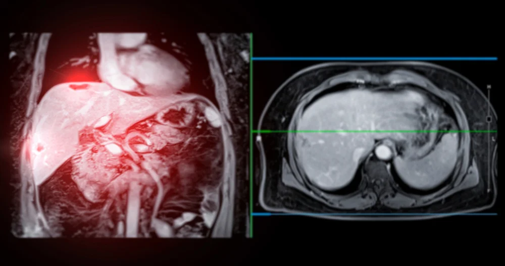 간암 원인과 치료방법 | 힐링오아시스