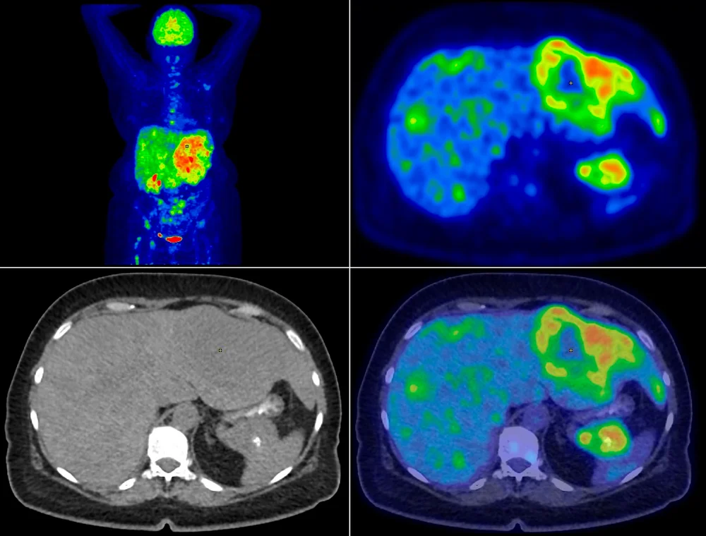 췌장암 초기증상 | 힐링오아시스