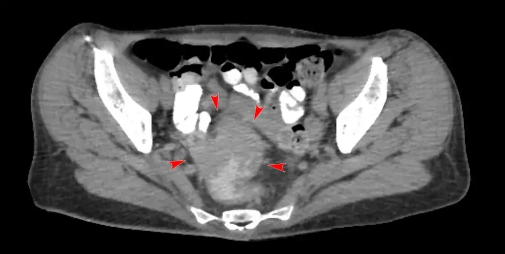 조기 발견 시 생존율과 치료 방법