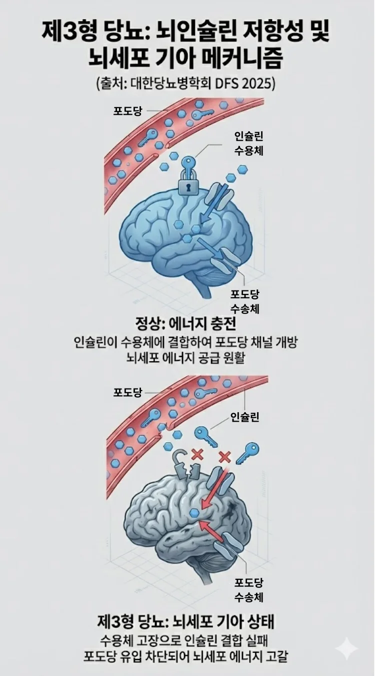 제3형 당뇨(뇌 인슐린 저항성) 메커니즘을 설명하는 가로형 인포그래픽. 좌측 '정상' 상태는 인슐린이 수용체에 결합해 포도당이 뇌세포로 원활히 공급되는 모습을, 우측 '제3형 당뇨' 상태는 수용체 고장으로 인슐린 결합이 차단되어 혈관 내 포도당이 뇌세포로 들어가지 못하고 뇌가 굶주려 위축되는 과정을 비교하여 보여준다. 