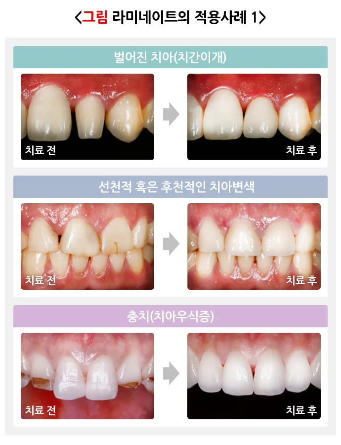 라미네이트의 적용사례 이미지