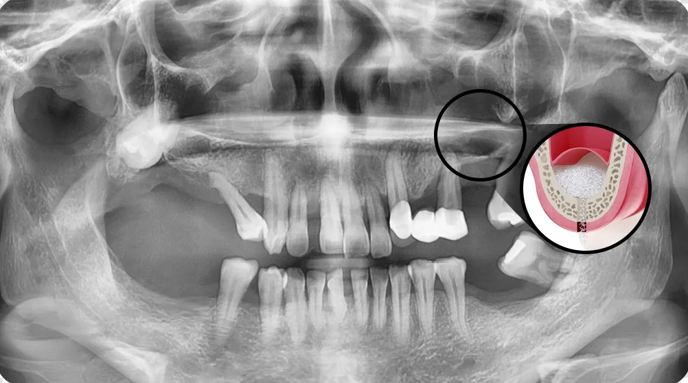 천안임플란트 서울비디치과의 상악동 거상술 X-ray