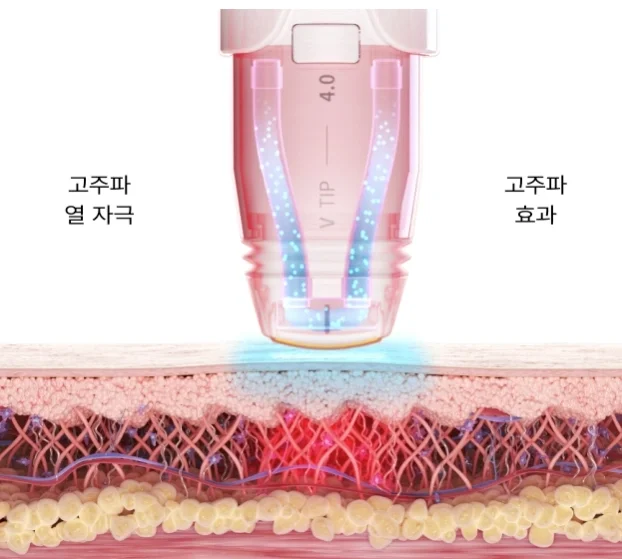 볼뉴머 고주파 시술 매커니즘 이미지