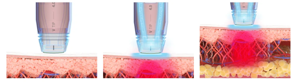 볼뉴머 고주파 시술 과정 이미지 