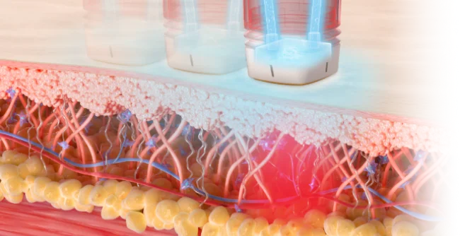 볼뉴머 수냉식 냉각 매커니즘