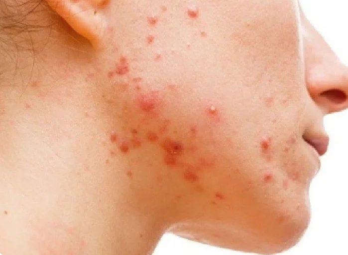 sensitive skin after face-wash