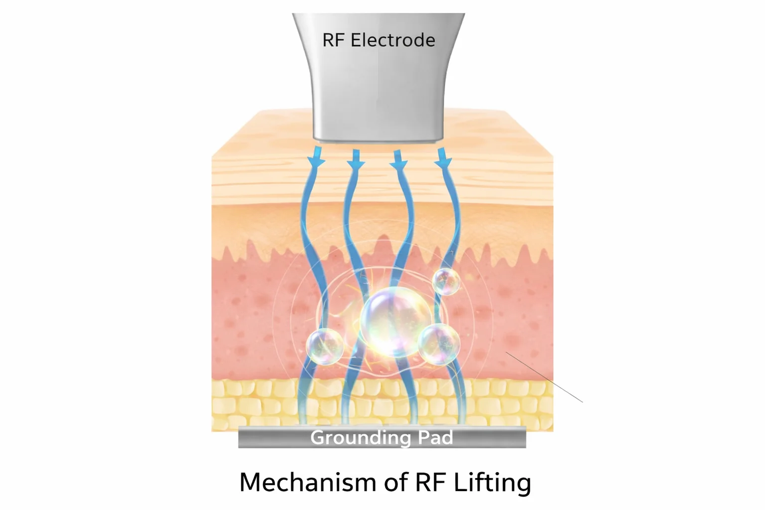 고주파 리프팅 원리 시각화 이미지