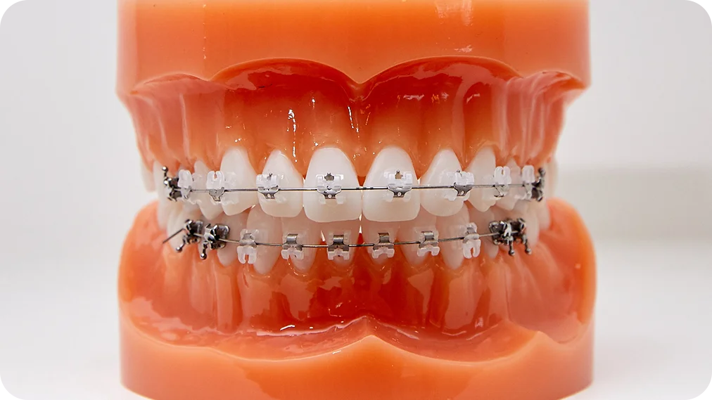 천안치과잘하는곳의 클리피씨 교정