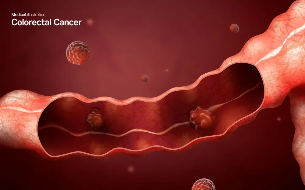 대장암 수술 후 회복 단계별 가이드