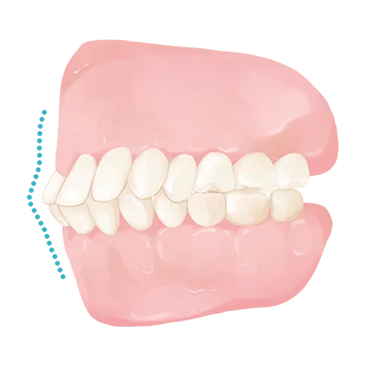 불당동치과 인비절라인 돌출입 상담 전 치아성 골격성 돌출입을 구분하는 측모 분석 장면